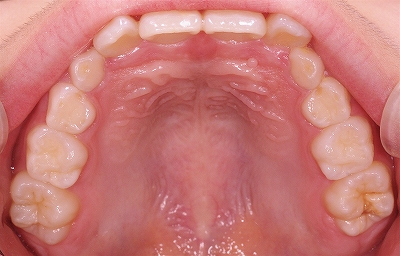 MIH（Molar Incisor Hypomineralization）とエナメル質形成不全